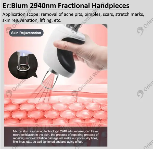 新しいスキン リニュー エキスパート - 2940nm エルビウム レーザー