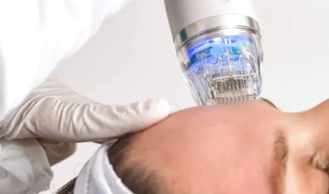 RFマイクロニードリング治療のメリットは何ですか？