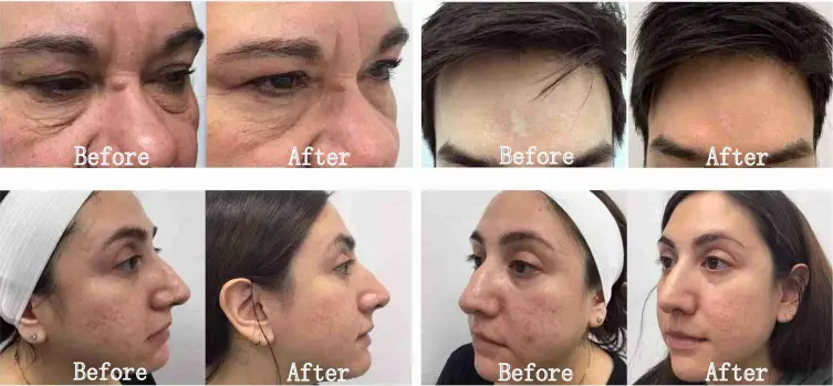 M8 Microneedle Rf Machine M8 Microneedle Rf Machine