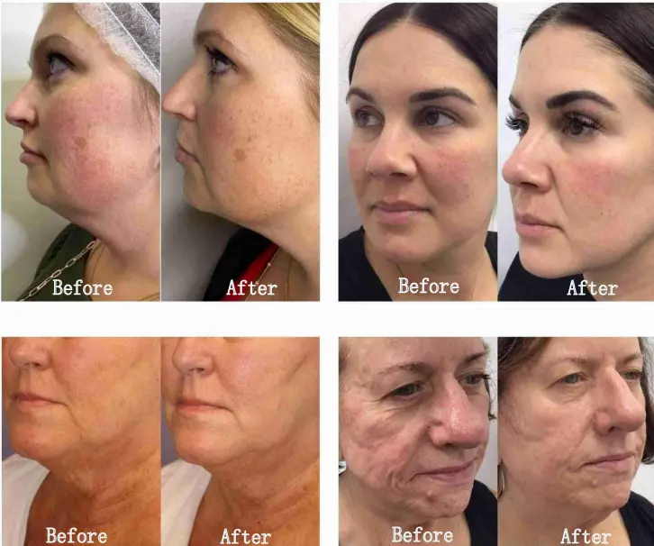 M8 Microneedle Rf Machine M8 Microneedle Rf Machine